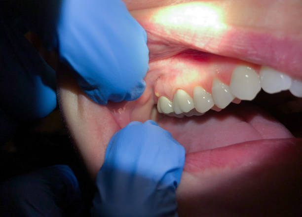 Best Emergency Broken Tooth Repair in Dexter, MI