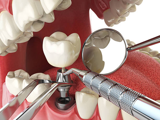 Best Emergency Tooth Extraction in Dexter, MI